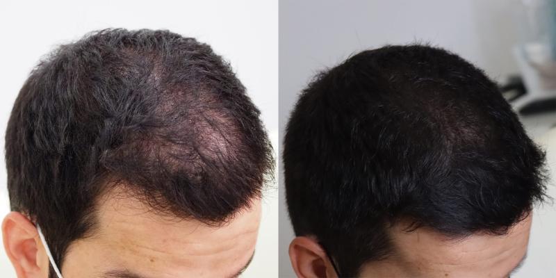 Recupera tu cabello con un implante capilar